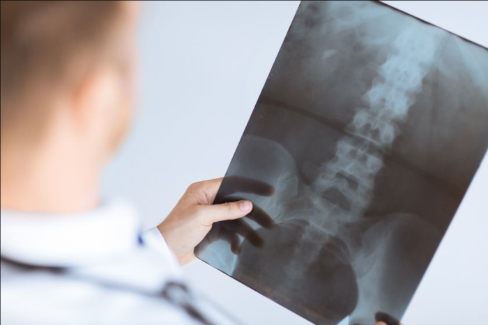 Spinal Stenosis Diagnosis Through Imaging Techniques