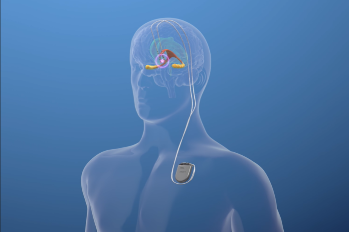 The Role of Multidisciplinary Teams in Deep Brain Stimulation (DBS ...