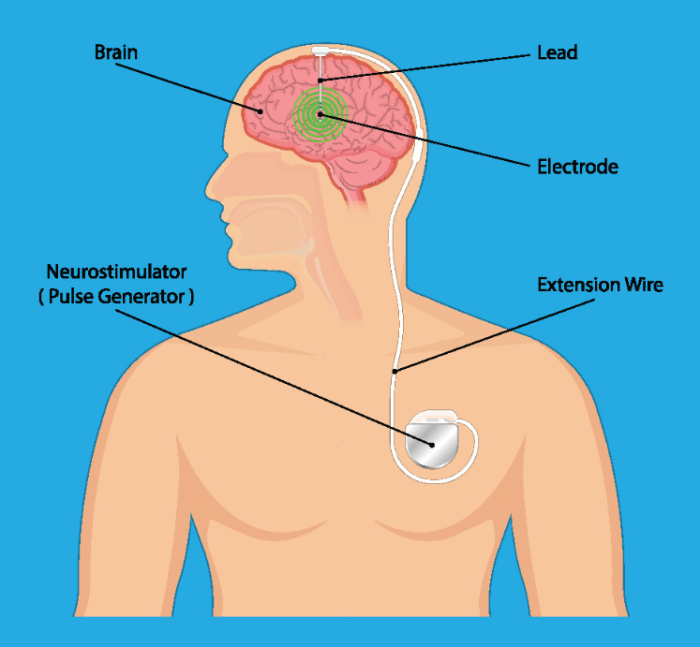 How the Length of DBS Treatment Influences Total Expenses