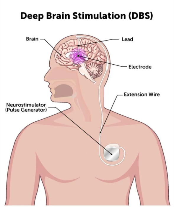 How DBS Works: A Brief Science Behind Deep Brain Stimulation