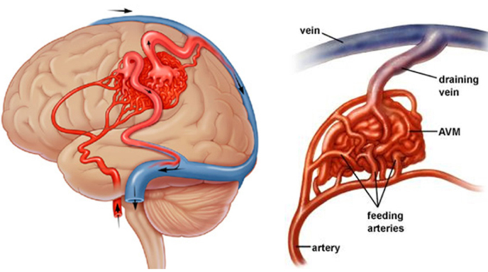 An Overview of Skull Base Surgery and Its Costs in India