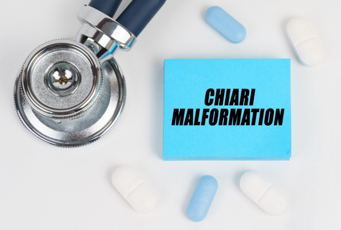 Non-Surgical Treatment Options for Chiari Malformation