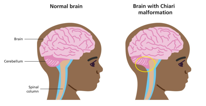 What to Expect After Chiari Malformation Surgery