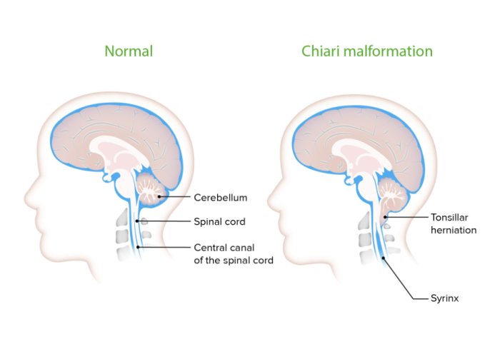 How Chiari Malformation Affects the Brain and Nervous System