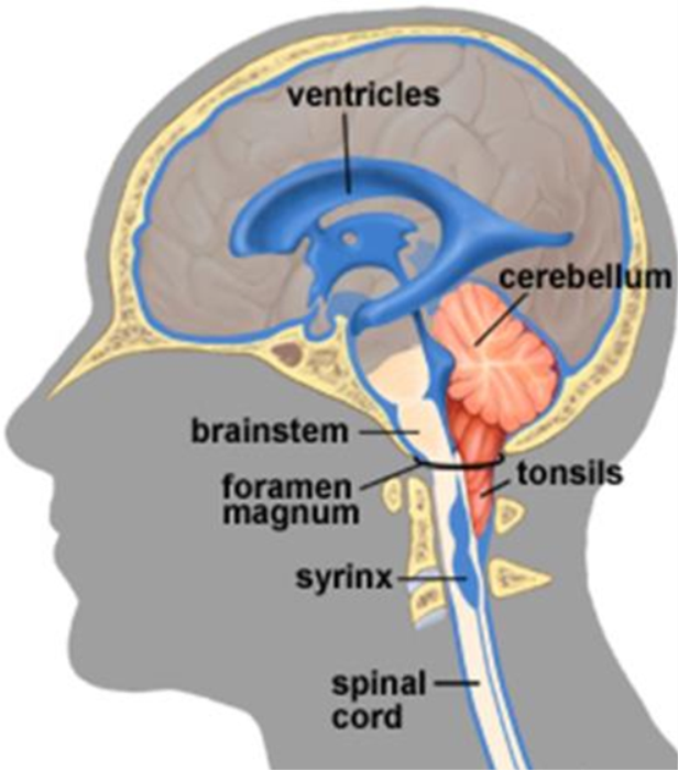 How CSF Flow is Disrupted in Chiari Malformation