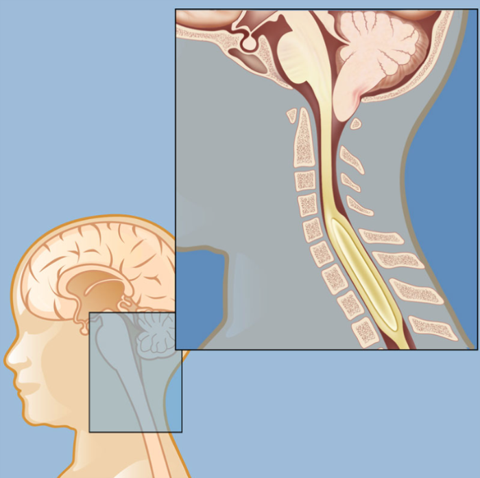 Understanding the Role of CSF in Cognitive Function in Chiari Malformation