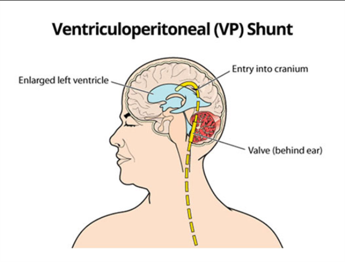 How Is VP Shunt Function Monitored After Surgery