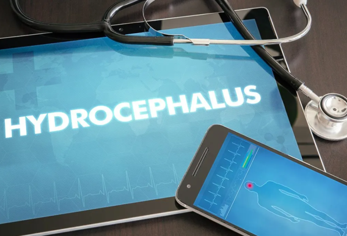 What Are the Latest Innovations in Hydrocephalus Treatment Technologies