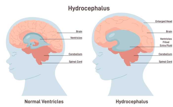 How Long Does Recovery Take After Hydrocephalus Surgery?