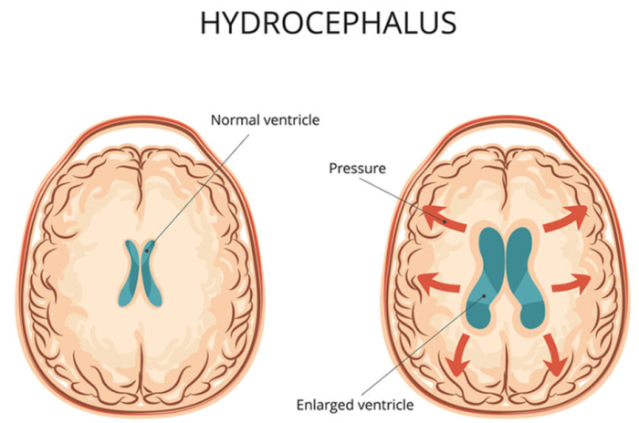 How Common Are Complications After VP Shunt Surgery?