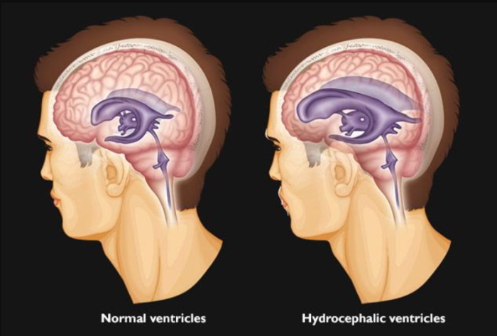 How Does the Success Rate of Hydrocephalus Surgery in India Compare Globally?