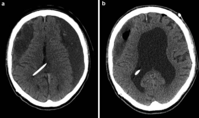 What Is the Role of Imaging in Improving Hydrocephalus Surgery Success Rates?