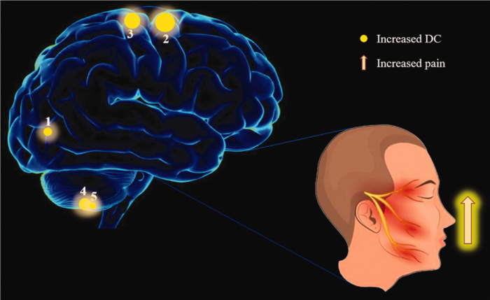 Are There Any Genetic Links Between Trigeminal Neuralgia and Other Pain Disorders?