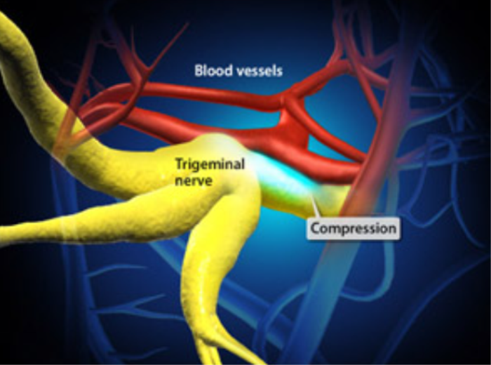 What Is the Role of the Blood Vessel-Nerve Conflict in Trigeminal Neuralgia?