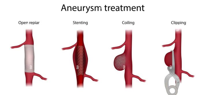 Best treatment for Preparing for Aneurysm Repair Surgery in India