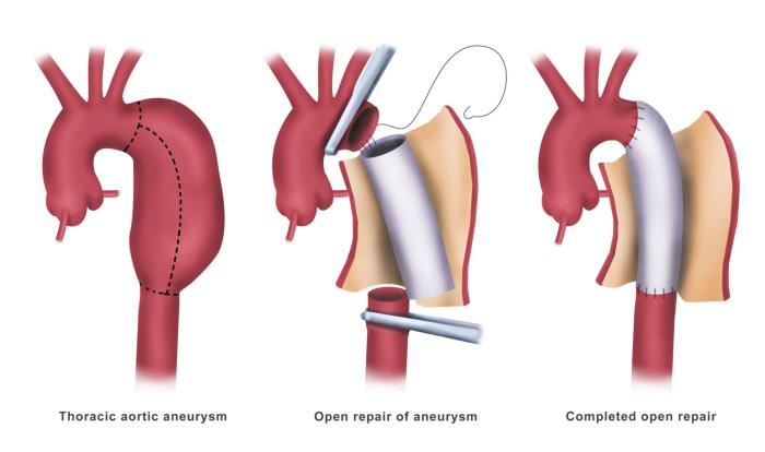 Preparing for Aneurysm Repair Surgery