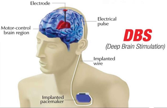 Best treatment for Deep Brain Stimulation (DBS) Surgery in India