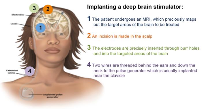 Best hospitals for Deep Brain Stimulation (DBS) Surgery in India