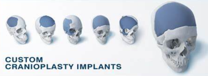 Best Cranioplasty Surgery in India