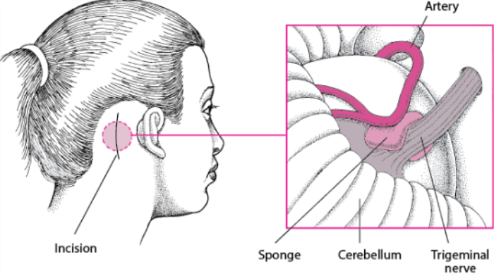 Best Surgery for Microvascular Decompression (MVD) Treatment in India