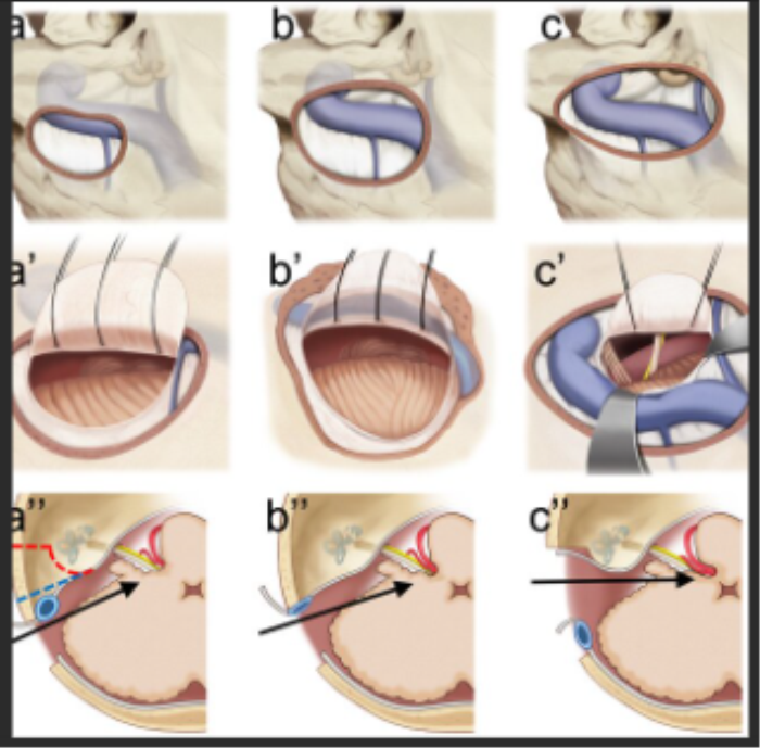 Best Hospital for Microvascular Decompression (MVD) Surgery in India