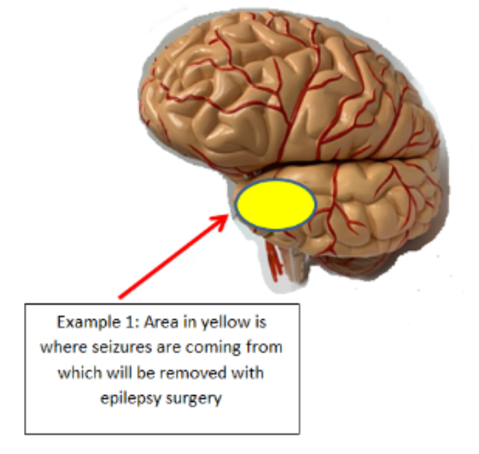 Best surgeries for Epilepsy treatment in India