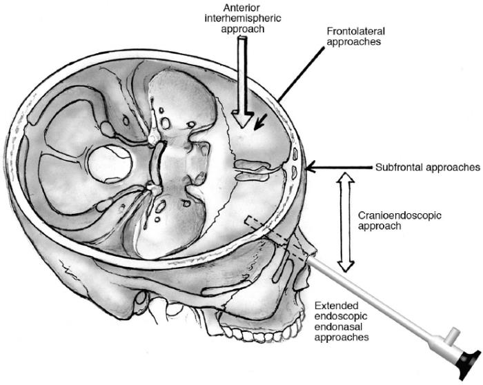 Type of Skull Base Surgery in India