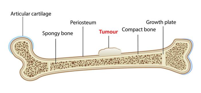 Symptoms of Secondary Bone Cancer