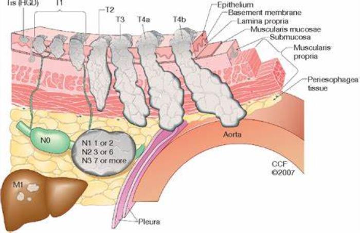 Understanding Staging of Esophageal Cancer