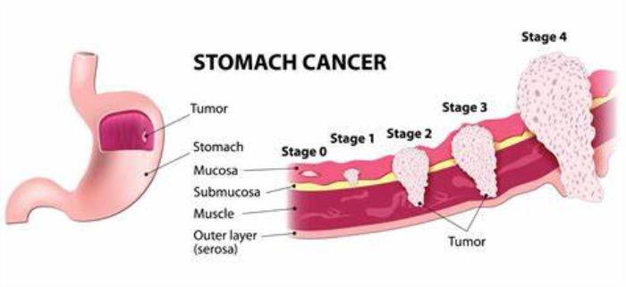 Key Roles of Oncologists in Stomach Cancer Treatment