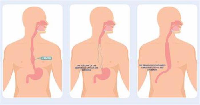 Traditional Methods of Esophageal Reconstruction