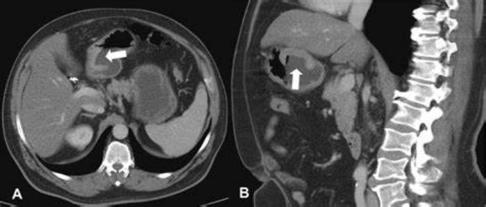 The Role of Radiologists in Stomach Cancer Management