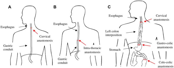 Long-term Outcomes and Quality of Life After Reconstruction