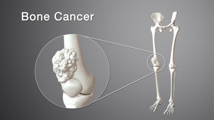 Factors Influencing Bone Health After Cancer Treatment