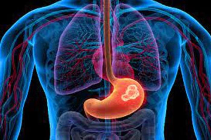 Understanding Risk Factors for Stomach Cancer