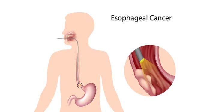 Risk Factors Associated with Esophageal Cancer