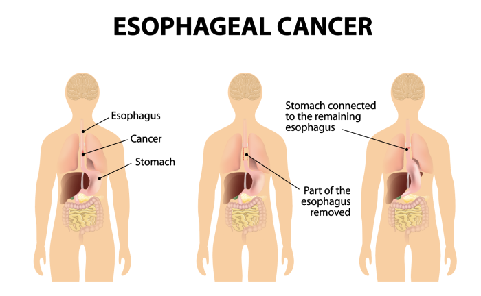 Types of Endoscopic Procedures Used in Esophageal Cancer