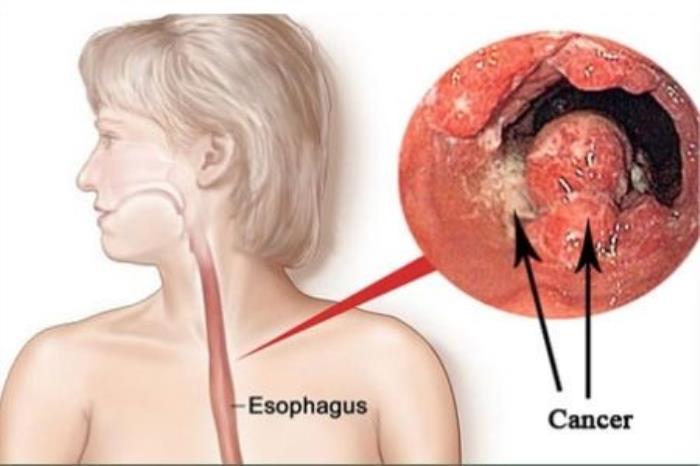 Role of Surgery in Esophageal Cancer Management