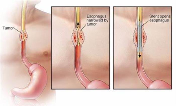 Limitations of Endoscopic Procedures in Esophageal Cancer Management