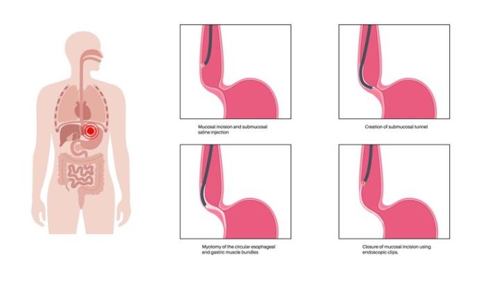 Long-Term Outcomes of Minimally Invasive Surgery for Esophageal Cancer