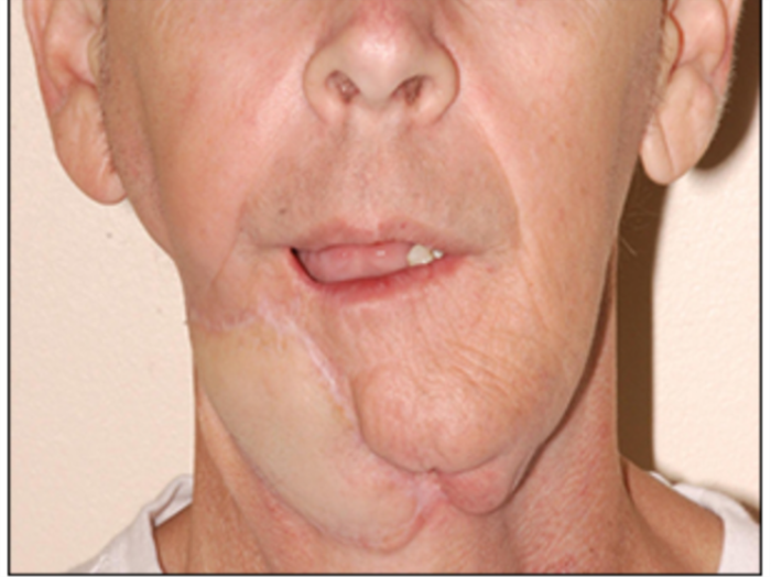 Reconstructive Jaw Surgery after oral or mouth cancer