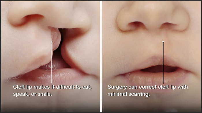 Reconstructive Surgery for Cleft Lip and Palate