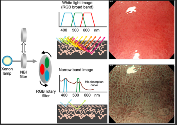 Light-Based Diagnostic Tools(Non-invasive) for Oral Cancer Detection - Narrow Band Imaging (NBI)