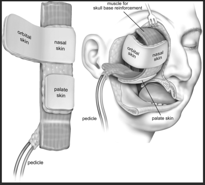 Microvascular Free Tissue Transfer