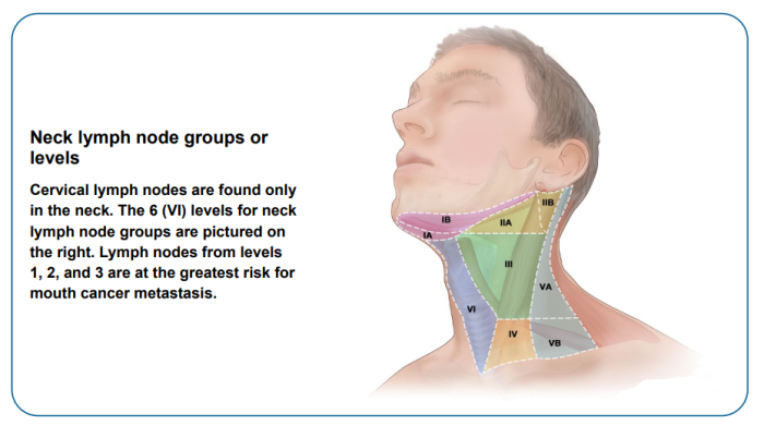 Mouth or Oral cancer - Neck lymph node groups or 
levels