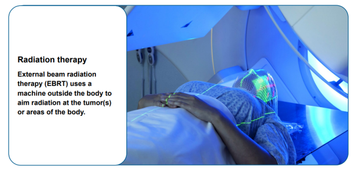 Mouth or Oral cancer - Radiation therapy