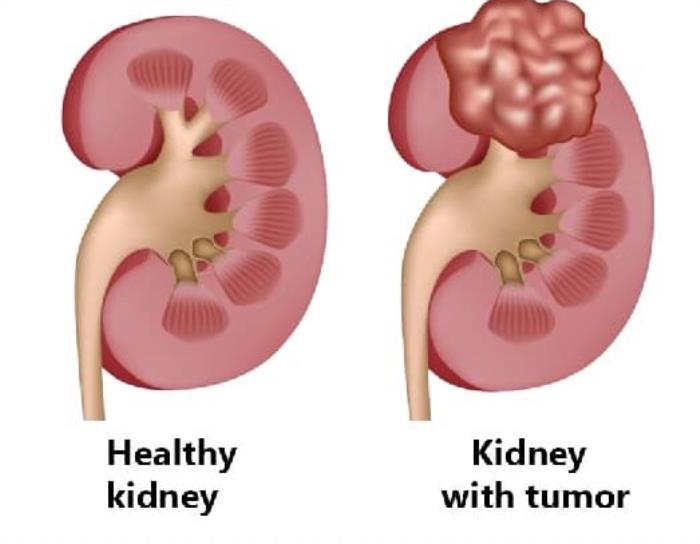 What is kidney cancer