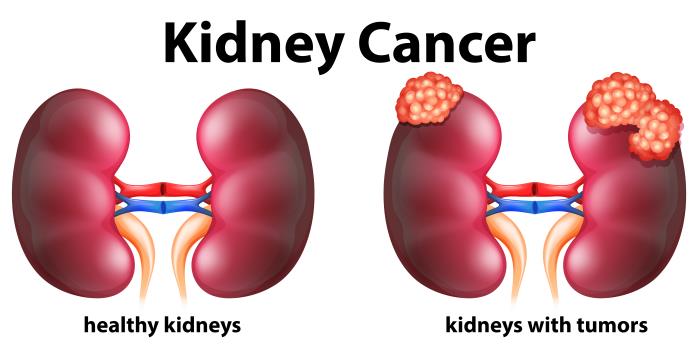 Types of Kidney cancer