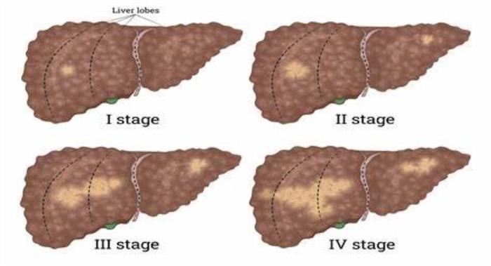 Arogyajivan Liver cancer Stages