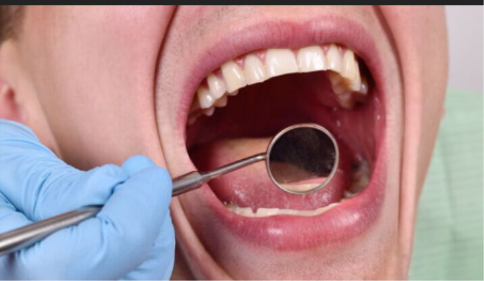 Best oral or mouth cancer treatment in india